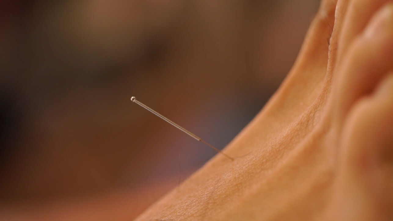 Science of Acupuncture Delcollo Acupuncture